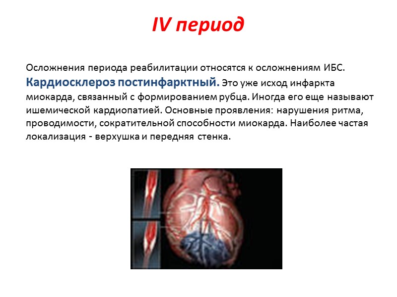 IV период    Осложнения периода реабилитации относятся к осложнениям ИБС. Кардиосклероз постинфарктный.